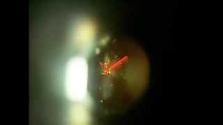 Amazing Eye Floater Membrane Treatment with Laser [upl. by Gilroy]