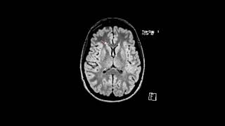 MS white matter lesions  First Look MRI [upl. by Heidy504]