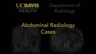 Hepatic steatosis MRI [upl. by Roon956]