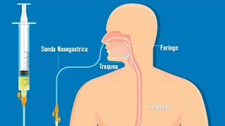 APRENDE Como COLOCAR Una Sonda NASOGÁSTRICA  Procedimientos De Enfermería  enfermeria [upl. by Wesle]