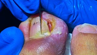 Badly Infected Ingrown Toenail Removal by Experienced Pedicurist [upl. by Ibok]