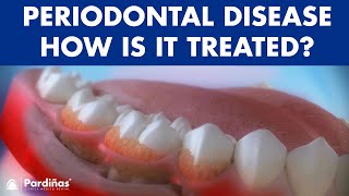 Periodontitis and its influence on health  How is periodontal disease treated © [upl. by Maer295]