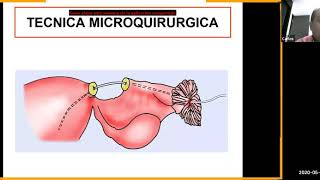 Recanalización tubarica por laparoscopia  MAY 21 [upl. by Rebecca808]