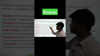 Rickets  causes  sign symptoms  diagnosis  treatment  in 1 min  rickets pksir [upl. by Ntisuj]