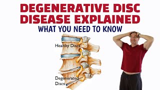 Degenerative Disc Disease Explained What You Need To Know [upl. by Avihs126]