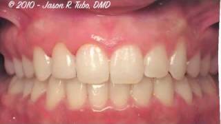 Invisalign  Before and After  Dr Jason Tubo  Northbridge Dentist [upl. by Edbert]