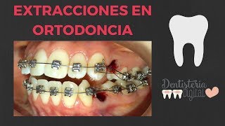 Extracciones en Ortodoncia  ¿Quién las necesita [upl. by Hannan]