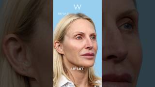 Surgical Lip Lift before and after results to enhance fullness and lip definition [upl. by Ahsyad]