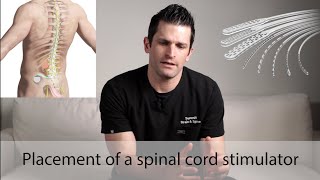 Spinal Cord Stimulator Placement [upl. by Ffirahs]