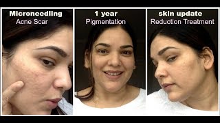 Microneedling 1 Year skin Update Acne scar reduction pigmentation old age wrinkles treatment [upl. by Dnomso17]