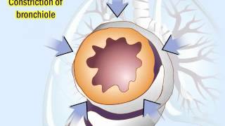 COPD Pathophysiology and Diagnosis [upl. by Orvie303]