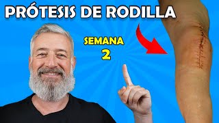 🦵 Semana 2 Prótesis de Rodilla Retirada de puntos Grapas y Ejercicios de Fortalecimiento [upl. by Eislehc]