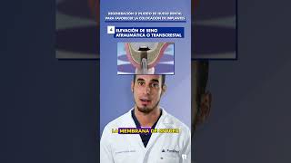 ELEVACIÓN de SENO ATRAUMÁTICA o transcrestal  Colocación de implantes en pacientes sin hueso [upl. by Siseneg]