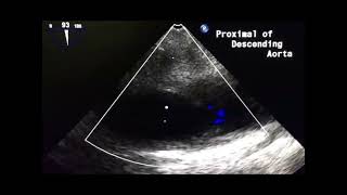 Aortic transection to drahmadmirdamadisilRFa2zzILyU5jpI [upl. by Haissem]