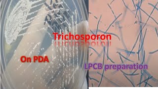 Trichosporon on SDA and LPCB preparation under the microscope [upl. by Ardnayek]