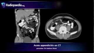 How to Interpret a Chest XRay Lesson 5  Cardiac Silhouette and Mediastinum [upl. by Mallin]