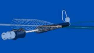 Zilver Vascular Stent [upl. by Aicilihp]