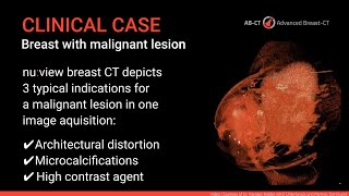 Clinical Case Breast CT images with contrast media enhancement [upl. by Sul810]