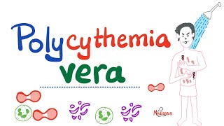 Polycythemia Vera PV  Myeloproliferative Neoplasm MPN  Erythrocytosis  Hematology [upl. by Ennayd]