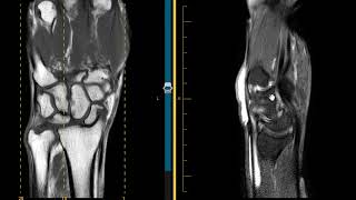 DISI and SLAC wrist scapholunate ligament tear and tenosynovitis [upl. by Aicillyhp]