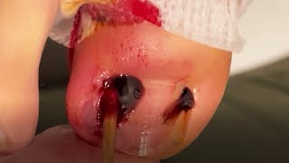 Huge ingrown toenail fungus treatment  Best video good health [upl. by Acherman]