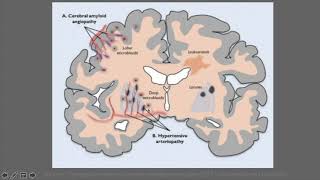 M4 Neuroradiologie à liECN Etiologies des AVC [upl. by Nothgierc]