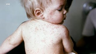 Your child has a viral rash but which one is it Here’s a comparison [upl. by Llebana]