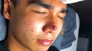 Remove Acne On Face ✦ Dr Laelia ✦ [upl. by Hugibert]