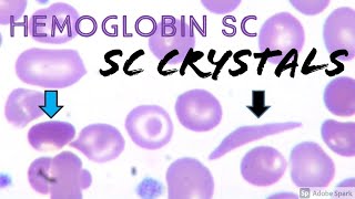 SC CrystalsCells in Hemoglobin SC Disease combo of Sickle Cell Anemia Hemoglobin S amp Hemoglobin C [upl. by Ume]