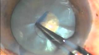 Capsulorhexis In Intumescent Cataract Surgeon  Dr Pradip Mohanta [upl. by Aicetal]