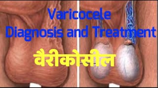 VARICOCELE  Symptoms Causes and Treatment in HINDI Dr Santosh Agrawal [upl. by Sax25]