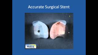 Immediate Denture Surgical Stent Fabrication [upl. by Irep438]