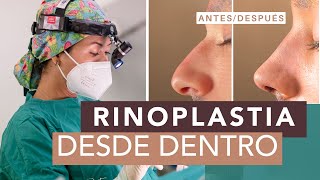 Rinoplastia Ultrasónica explicada👃🏻 Procedimiento y ventajas 🤩 [upl. by Maje]