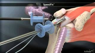 Arthrex SpeedFix rotator cuff repair animation [upl. by Hescock]