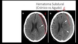 Hematoma Subdural  Tomografía Computarizada Hemorragia Intracraneal [upl. by Lahcar457]