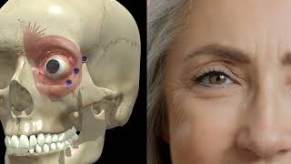 Correct Injection Points for Crows Feet Crows feet Botox Technique [upl. by Caffrey]