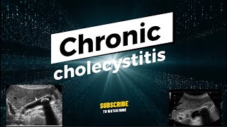 Chronic cholecystitis ultrasound echography Chronic cholecystitis Cholécystite chronique [upl. by Medwin]