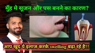 मुँह में pimple बनकर पस आता है और सूजन आ रही है [upl. by Previdi891]