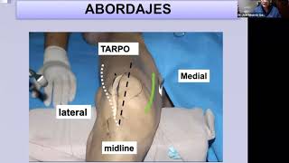 Webinar MIO en fémur distal indicaciones técnica y complicaciones [upl. by Minabe940]