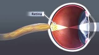 Animation Cataract [upl. by Casabonne]