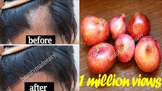 Grow your Hair Faster with Onion Juice  STOP Hair Fall with Home Remedy  100 Working [upl. by Odilo152]