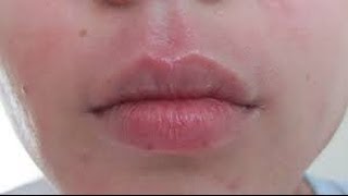 How to get rid of Perioral Dermatitis [upl. by Kayne833]