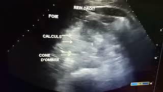 Echographie abdominale calcul rénal [upl. by Ailisec]