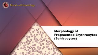 Morphology of Fragmented Erythrocytes Schistocytes [upl. by Prentice]