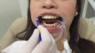 Nonperoxide Teeth Whitening [upl. by Asecnarf]