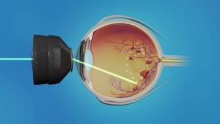 Medication Injection and Laser Surgery for Macular Edema [upl. by Okihsoy]