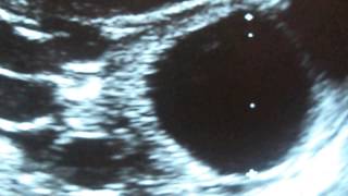 Ultrasonido de quiste en Ovario Ovarian cyst ultrasound [upl. by Ahdar]