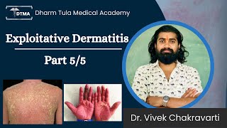 Dermatitis  Exfoliative Dermatitis Hindi  Types  Part 55 Eczema  Skin Disease  Skin Infection [upl. by Midian197]