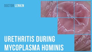 👉 Urethritis during mycoplasma hominis [upl. by Galen612]