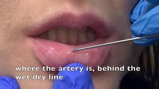 Lip filler injection [upl. by Rothstein]